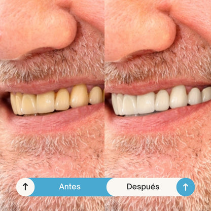 FLASH SMILE | Recupera la salud de tu sonrisa