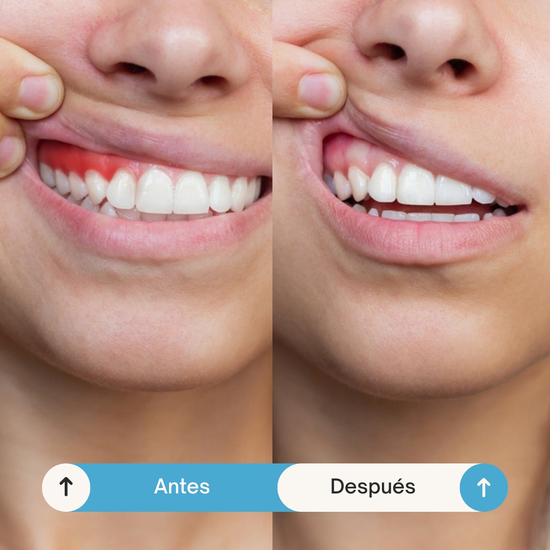 FLASH SMILE | Recupera la salud de tu sonrisa