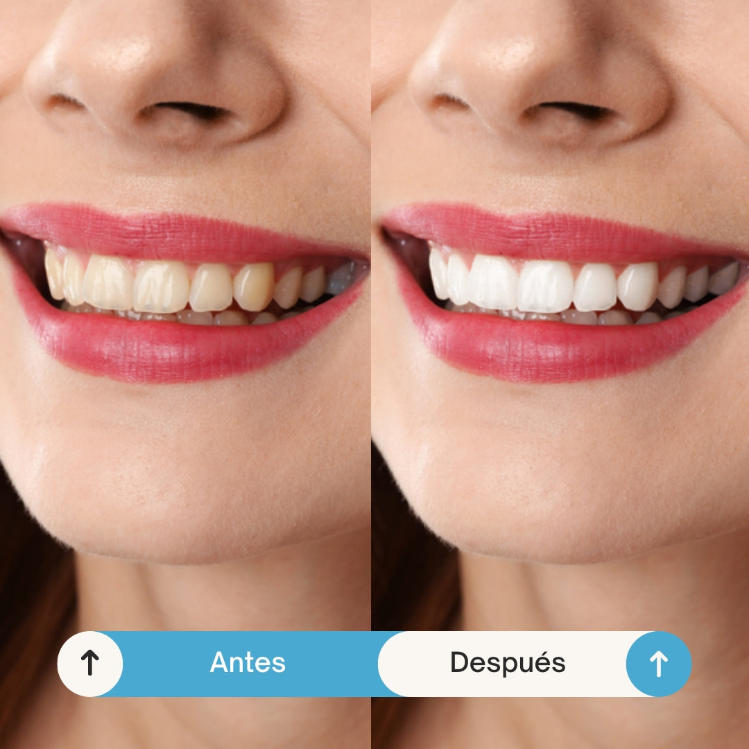 FLASH SMILE | Recupera la salud de tu sonrisa